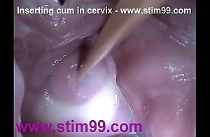 Interpolate cream cum in cervix almost dilatation slit reflector